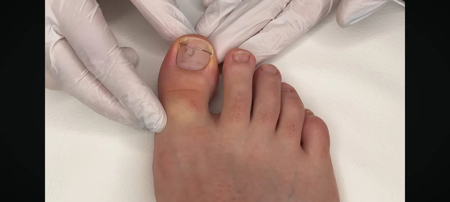 Podologische Praxis Praxis für Podologie Medizinische Fußpflege Fußbehandlung Fußgesundheit Podologische Therapie Podologische Praxis Gersthofen Fußpflege Gersthofen Eingewachsenen Nägeln Nagelspange Ross-Fraser, Onyfix