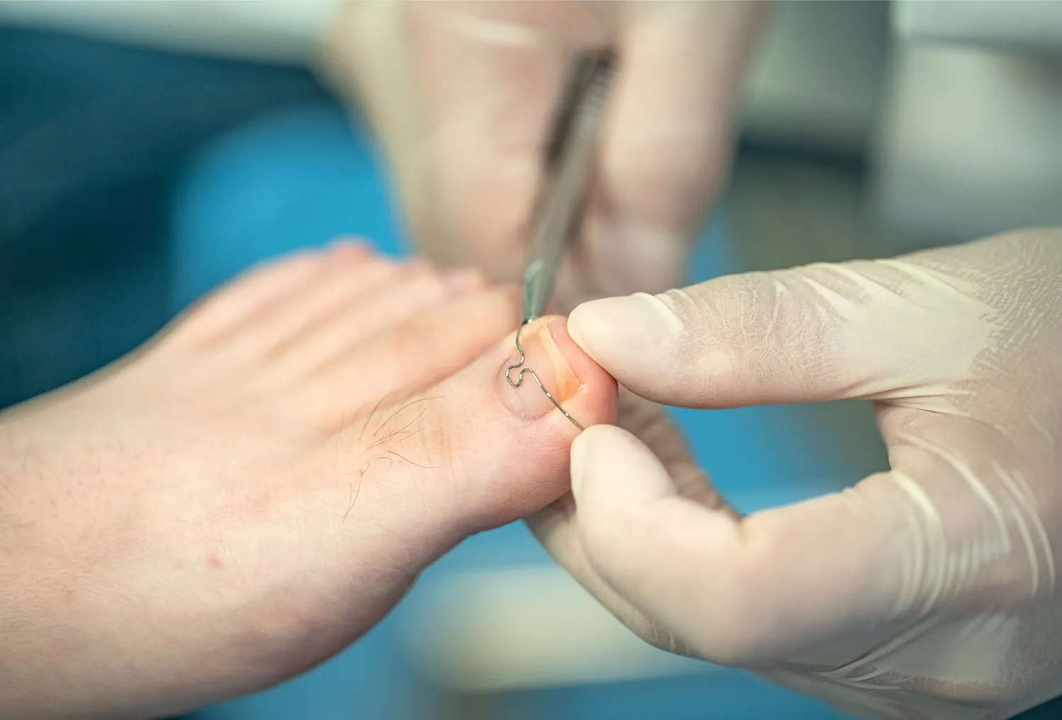 Spangenbehandlung Orthonyxie  Heilmittelveordnung Podologie mit Zulassung  Hornhaut Behandlung Hühneraugen Behandlung Diabetische Fuß Diabetische Fußsyndrom Diabetische Neuropathie Schrunden Behandlung Rissige Haut Trockene Haut Akute Nagelschmerzen Fußcreme Fußschaum Schrundencreme